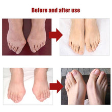 Load image into Gallery viewer, 1Pair Silicone Toes Separator Bunion Bone Corrector
